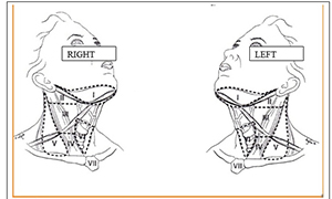 Mapping Of Neck Lymph Nodes For Thyroid Cancer
